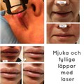 1 co2 laser för läppar leilasspa.jpeg