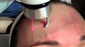 fractional laser.jpg