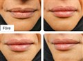 hyaluron pen leilasspa 2.jpg